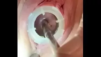 चलाएँ दर्द से कराहते हुए मेरे गर्भाशय ग्रीवा को पकते हुए 8 मिमी इलेक्ट्रोसाउंड देखें